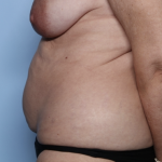 Tummy Tuck Before & After Patient #34291